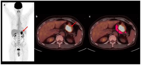 Predicting the Recurrence of Gastric Cancer Using the Textural Features ...