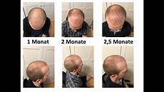 auto leasing 2 monate teil 4 2 5 monate post op haartransplantation t 252 rkei auto leasing 2 monate teil 4 2 5 monate post op haartransplantation t 252 rkei