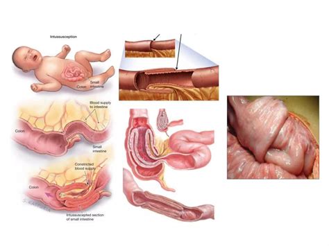 Image result for Intussusception Symptoms