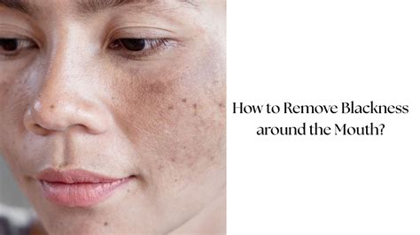 How to Remove Hyperpigmentation Around Mouth?