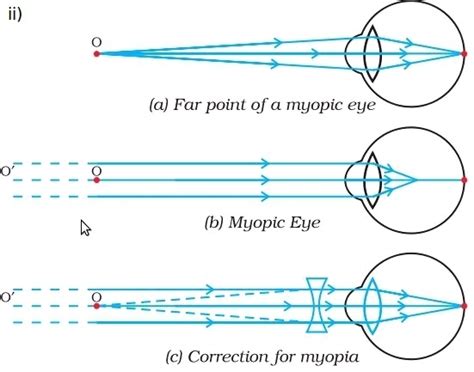 A student suffering from myopia is not able to see distinctly the ...
