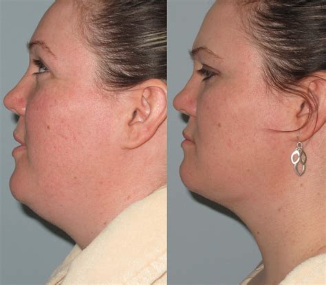 Liposculpture Double Chin