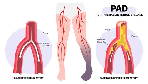 What is an Angioplasty Procedure? | American Endovascular
