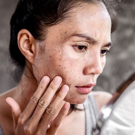 Navigating the World of Blemishes and Scars – Serumique