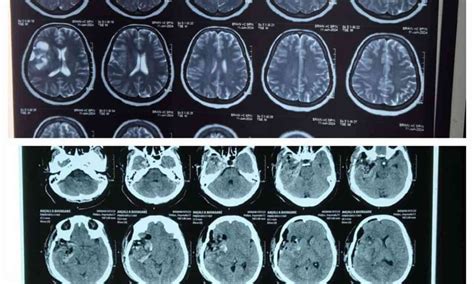 Epidermoid Tumor Successfully Removed at Apex Group of Hospitals