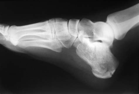 File:Calcaneus Fracture.jpg - Wikimedia Commons