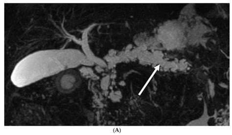 Utility of Radiological Follow Up of Main-Duct Intraductal Papillary ...