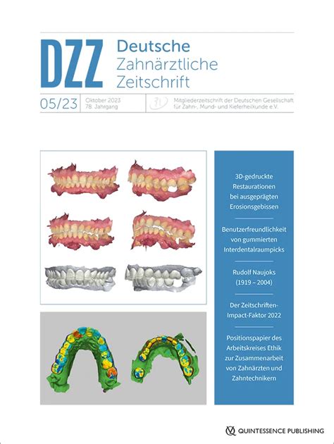 S3-Leitlinie: „Einsatz von Platelet-Rich-Fibrin (PRF) in der dentalen ...
