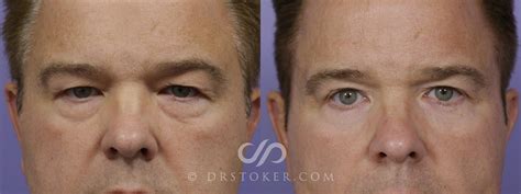 How To Get Rid of Bags Under the Eyes: Men’s Treatment Guide – Dr. David Stoker