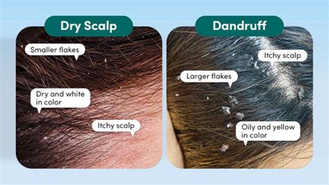 Scalp Dandruff 的图像结果