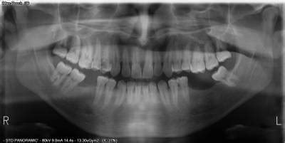 Teeth Segmentation on Dental X-ray Images - Dataset Ninja