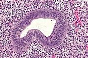 Image result for Disordered Proliferative Endometrium