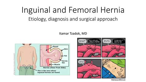 Inguinal and femoral hernia | PPTX