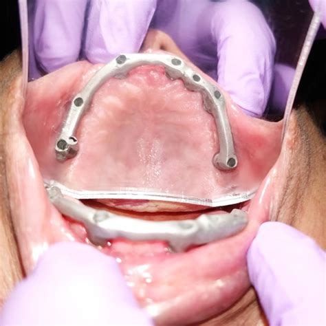 Best Dental implants in noida| Near me