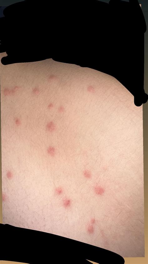 Gnat bites or bedbugs? : r/whatisthisbug
