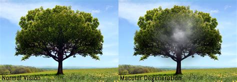 Image result for Macular Degeneration Example