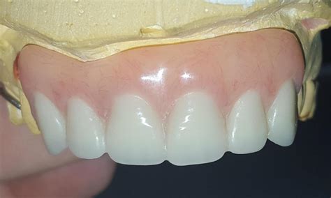Image result for Front Teeth Partials Options
