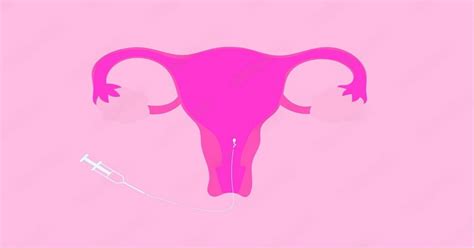 How Is IUI Procedure Done 的图像结果