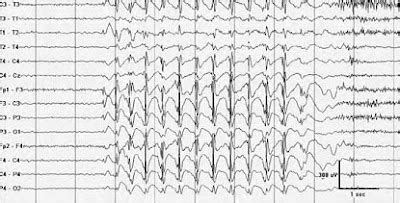MCQ. Electoencephalography (EEG) ~ Nursing Path