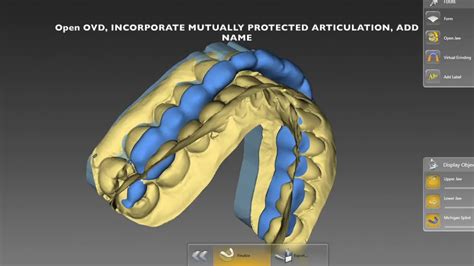 Image result for Inlab Splint Design
