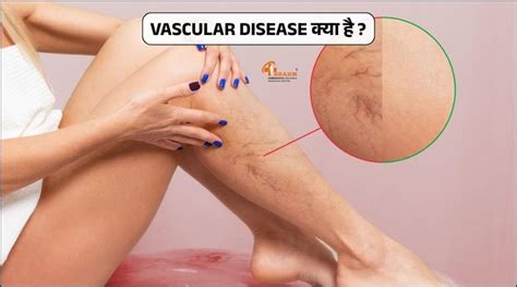 AVN Treatment | AVN Treatment In Homeopathy | Avascular Necrosis Treatment