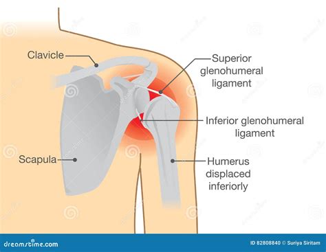 Dislocation Shoulder Symptoms or Separated. Stock Vector - Illustration of nerves, exercise ...