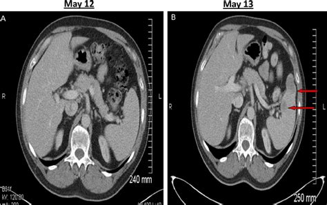 Image result for Normal Profile CT