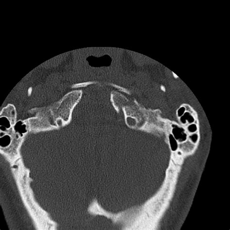 Occipital condyle fracture (Radiopaedia 31755-32691 Axial bone window ...