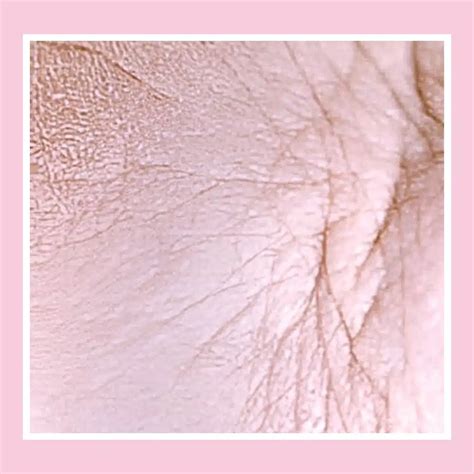 Crepey Skin Treatments | Dermal Health London