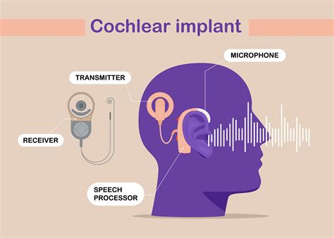 Cochlear Implants | Auditorey
