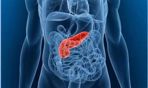 Women with polycystic ovary syndrome at higher risk of pancreatic ...
