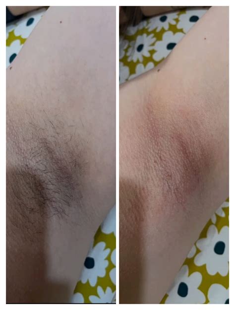 DermaLAB - The Best Laser Hair Removal Clinic in Jamshedpur.Dr Deep ...