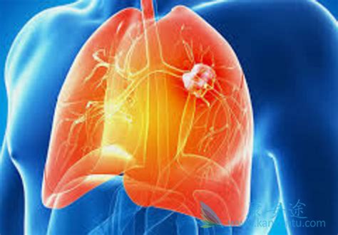 肺癌晚期能活多久跟患者后期的治疗和护理有关-康安途海外医疗