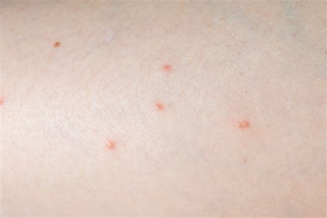 What Spider Bites Look Like—and When to Call the Doctor | RD.ca