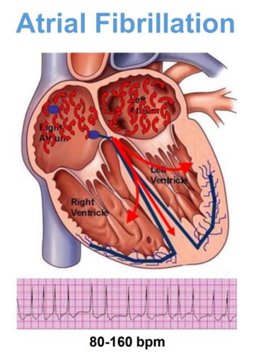 Atrial Fibrillation 的图像结果