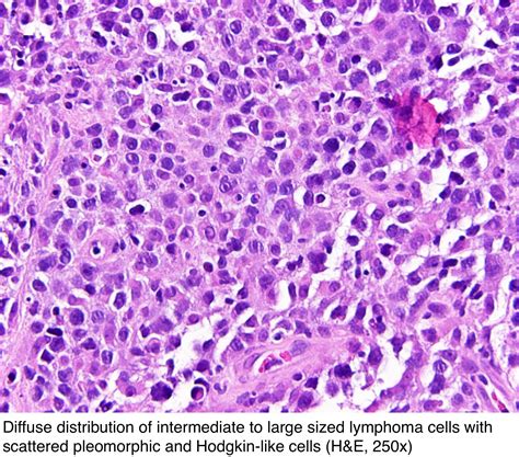 Primary Mediastinal Bcell Lymphoma