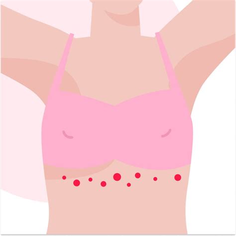 Rash Under Breast: What Causes It and How to Treat It? (Including ...