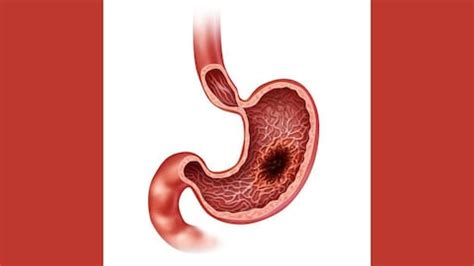 Cáncer de estómago