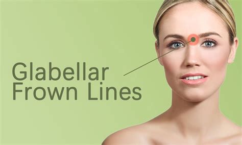 Glabellar Frown Lines Treatment in Surat - Elegance Clinic