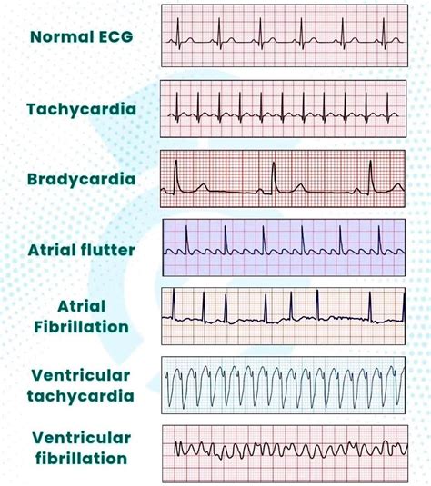 Best 13 ECG changes due to electrolyte imbalance (disorder) – Artofit