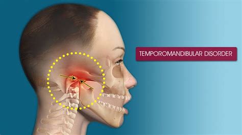TEMPOROMANDIBULAR DISORERS(TMD) – Dentowesome