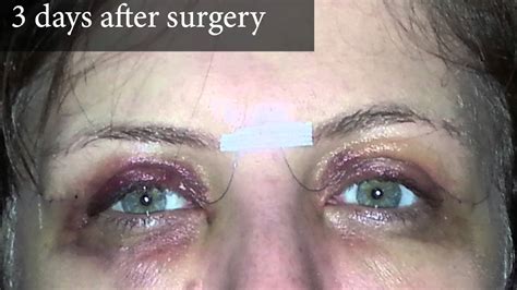 How To Reduce Eye Swelling Immediately at Brittany Fox blog