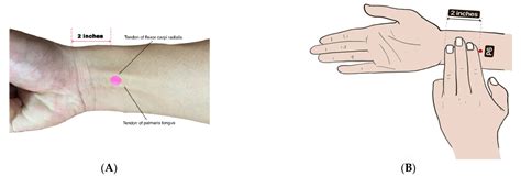 Effect of Acupressure at P6 on Nausea and Vomiting in Women with ...