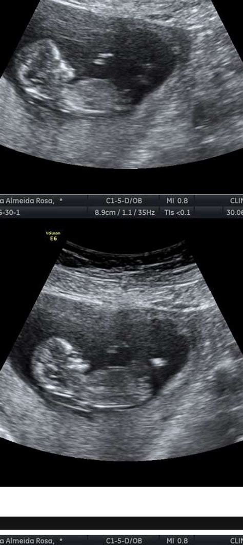 Tubérculo genital | BabyCenter