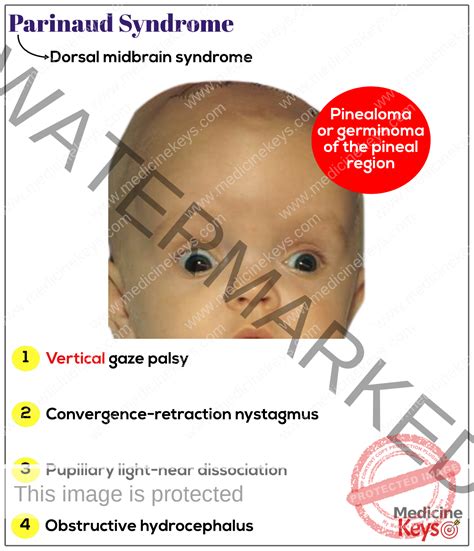 Sindrome Oculoglandular De Parinaud Case Series Of Parinaud's