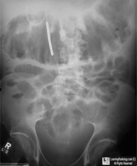 Image result for Exploding Colon