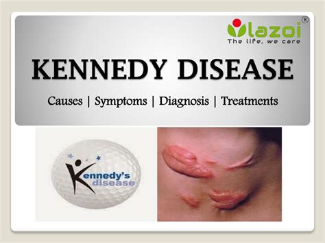 Kennedy Terminal Ulcer Images at Norman Nelson blog