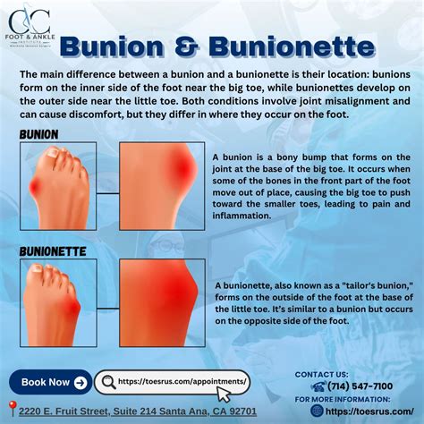 #bunionrelief #bunionettetreatment #foothealth #footpainrelief #podiatristsantaana # ...