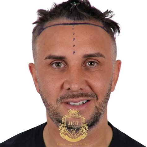 Keiran Lee Hair Transplant - Hair Center of Turkey