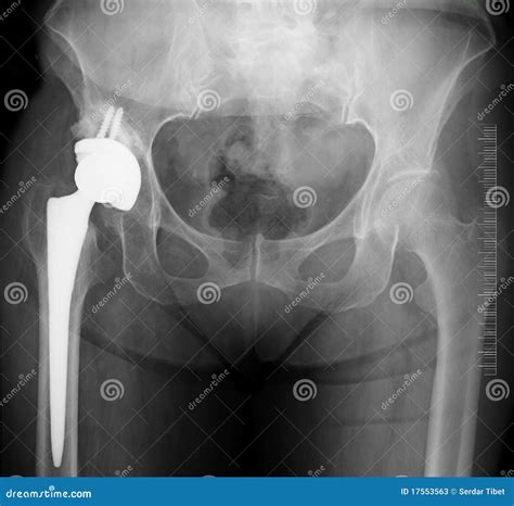Hip Replacement X-ray Stock Photos - Image: 17553563